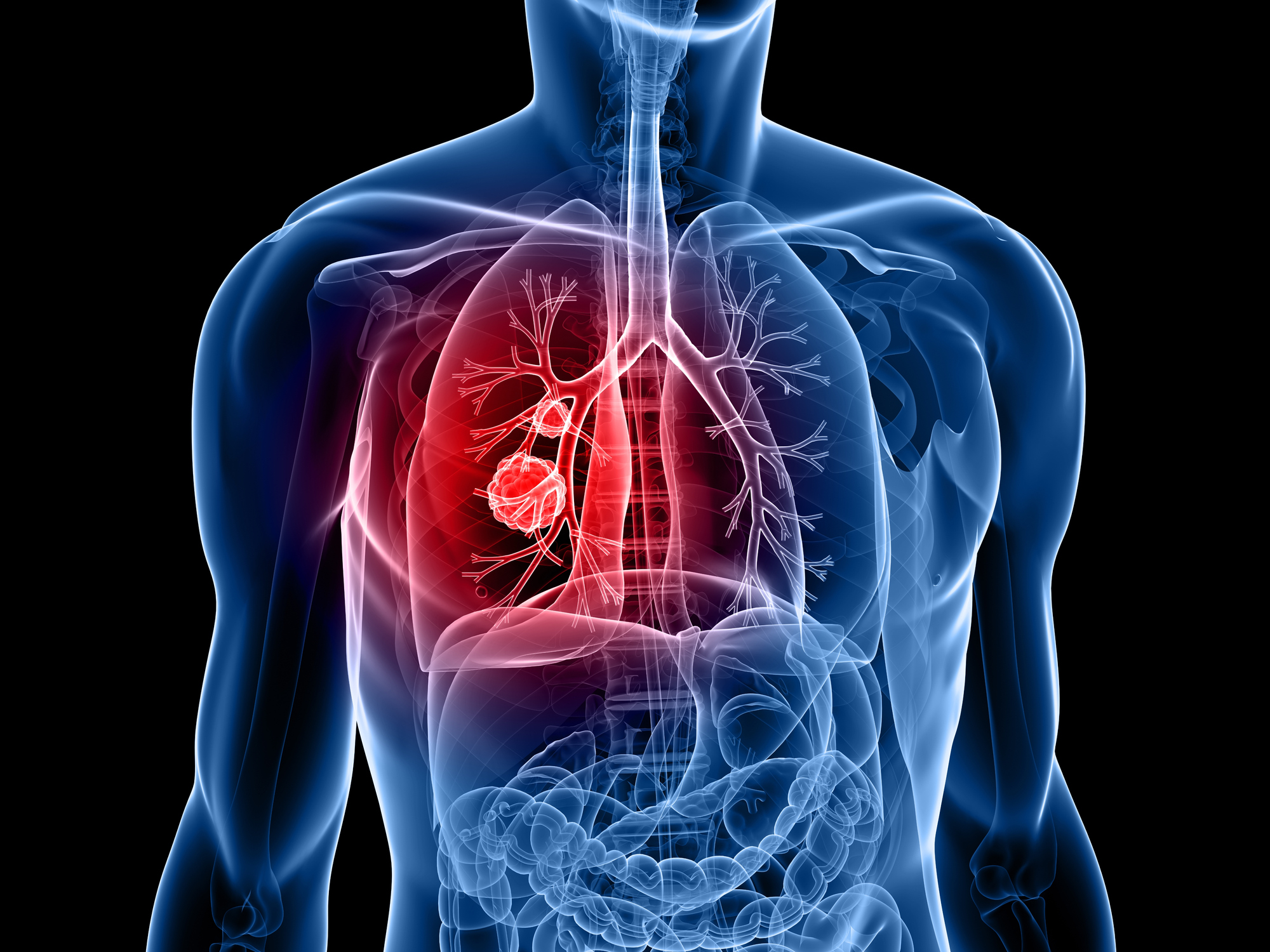 Lorviqua godkänt i EU som en första linjens behandling för ALK-positiv avancerad lungcancer