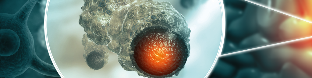 Stamcellsliknande tumörcell kan förklara resistens vid glioblastom